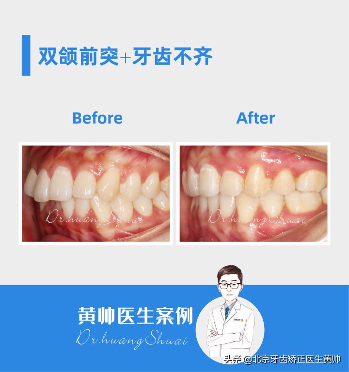 嘴凸的人怎么笑起来好看,嘴凸怎么让自己不焦虑