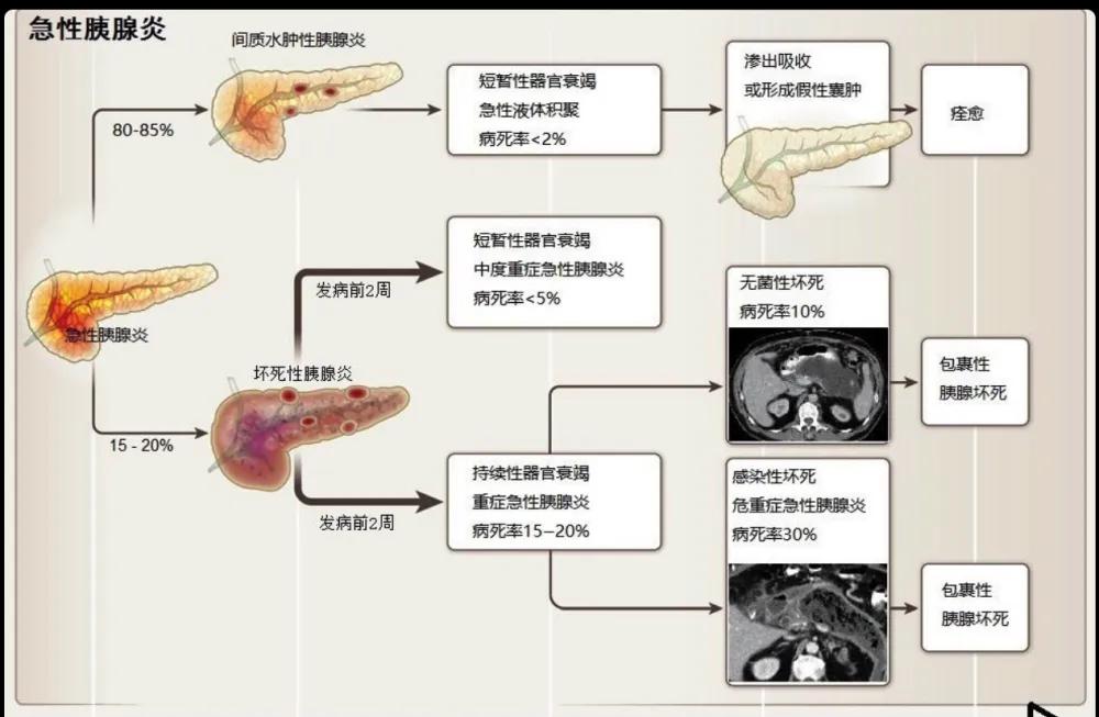 老人突然肚子疼确诊胰腺炎,小伙胰腺炎腹痛难忍