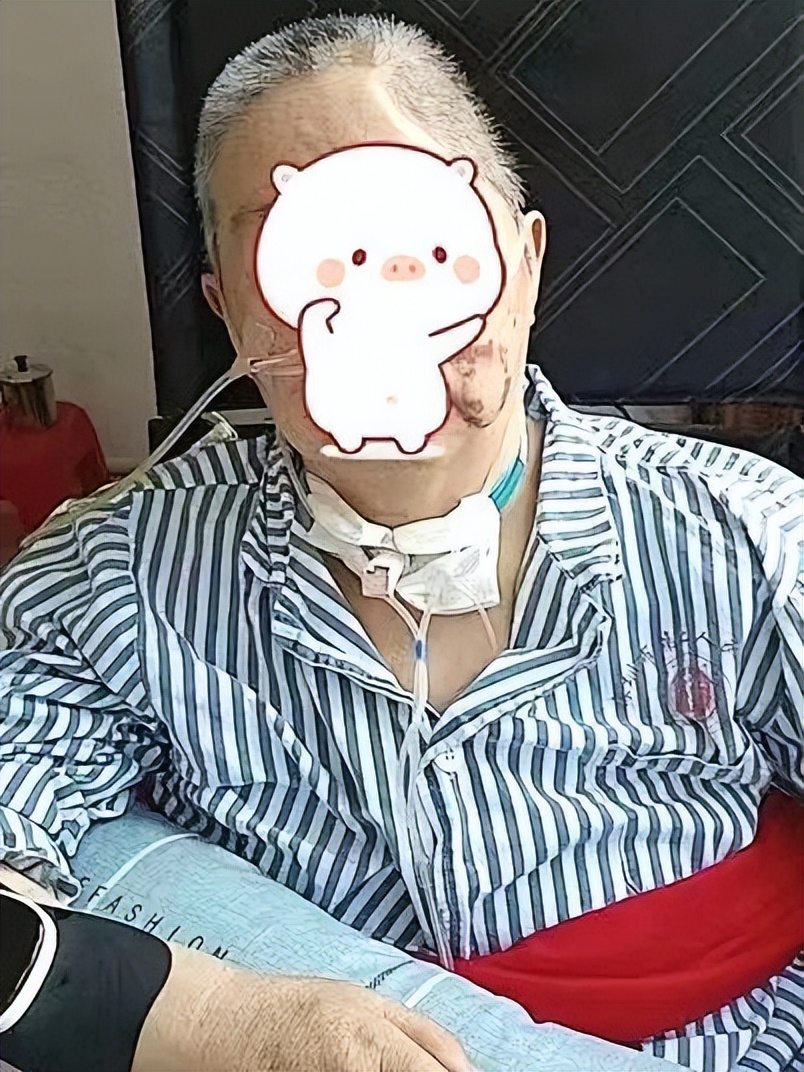 气管切开脱不了呼吸机怎么办,气管插管病人拔不了管怎么办