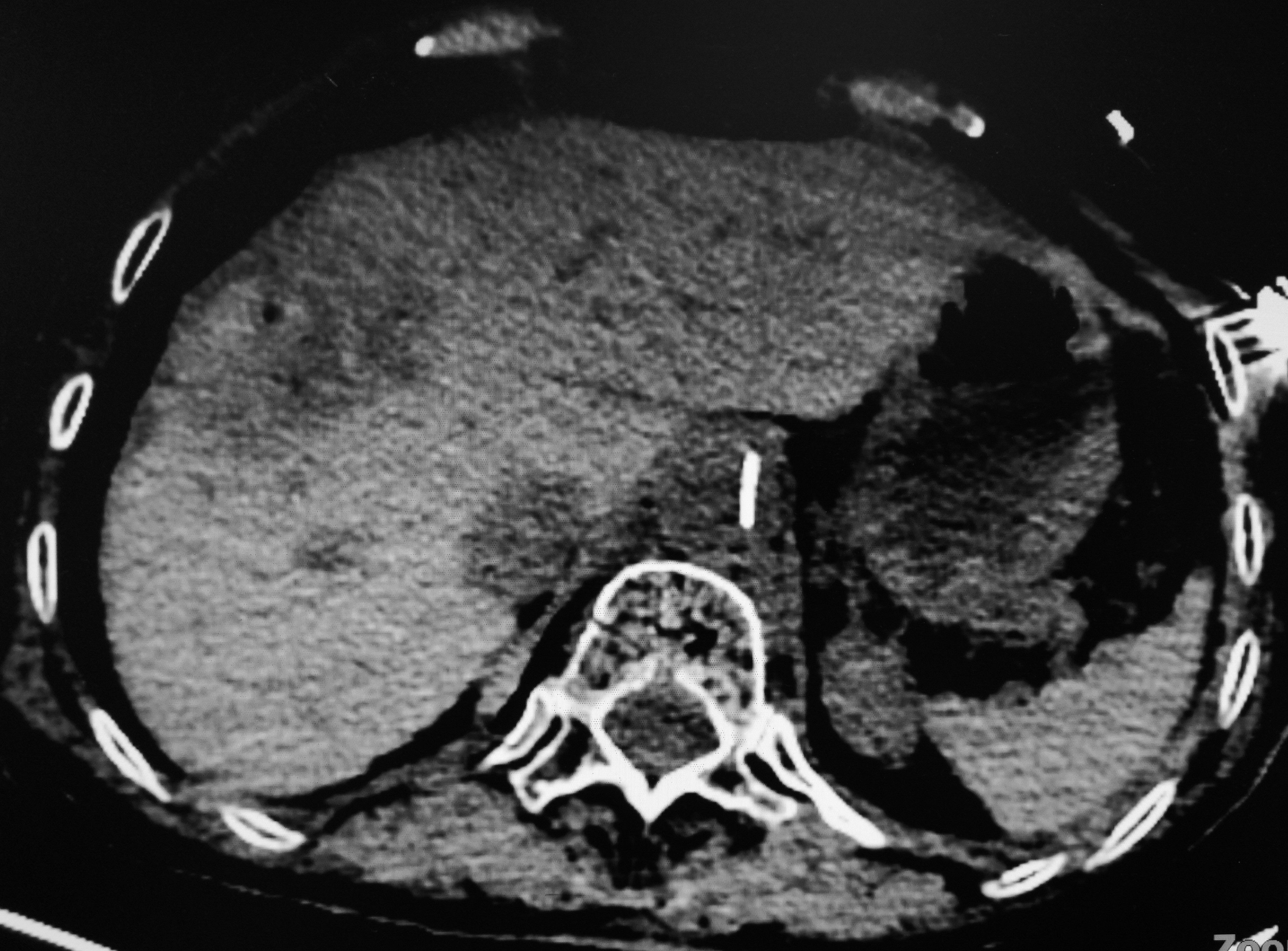 肠癌肝转移先做化疗还是介入,肠癌肝转移介入治疗哪里做得好