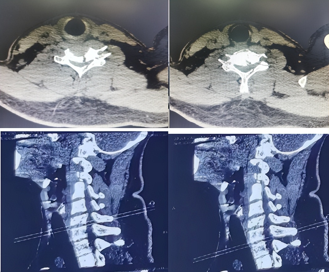 救治背部被砸伤男子,男子救人被砸中在icu抢救超24小时