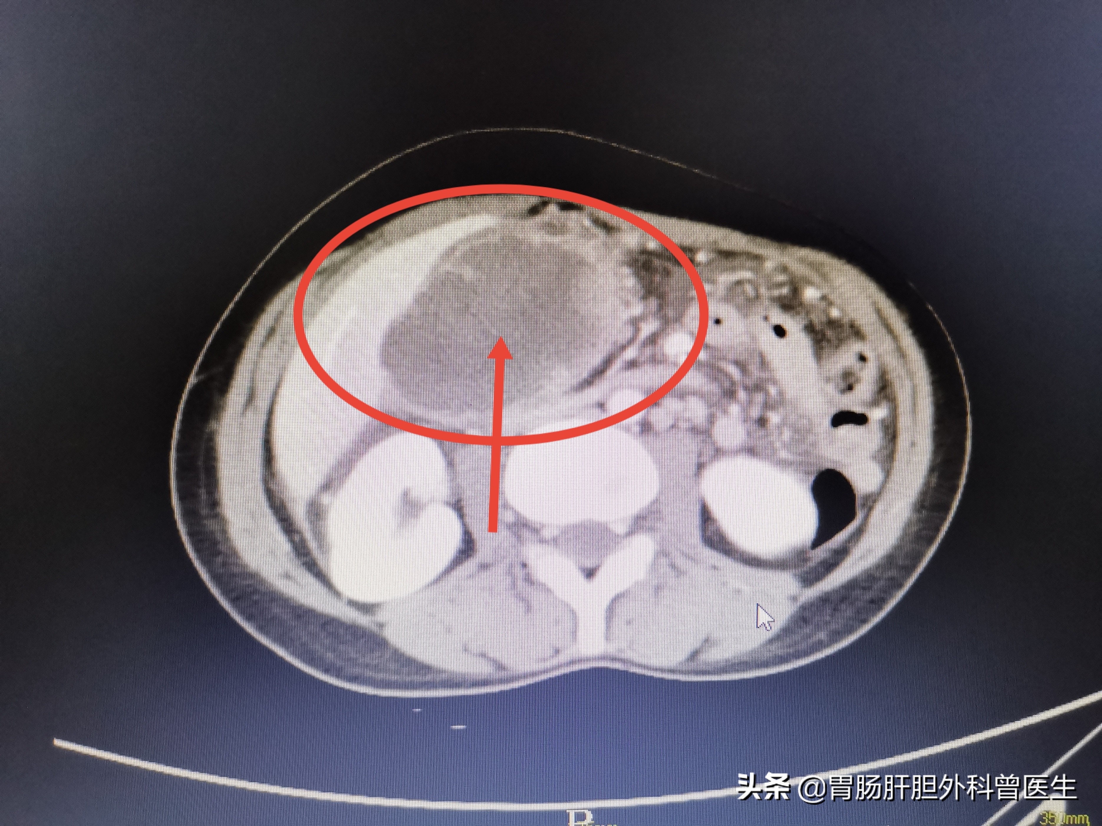 胆囊息肉胆囊癌患者真实经历,胆囊息肉没处理胆囊癌