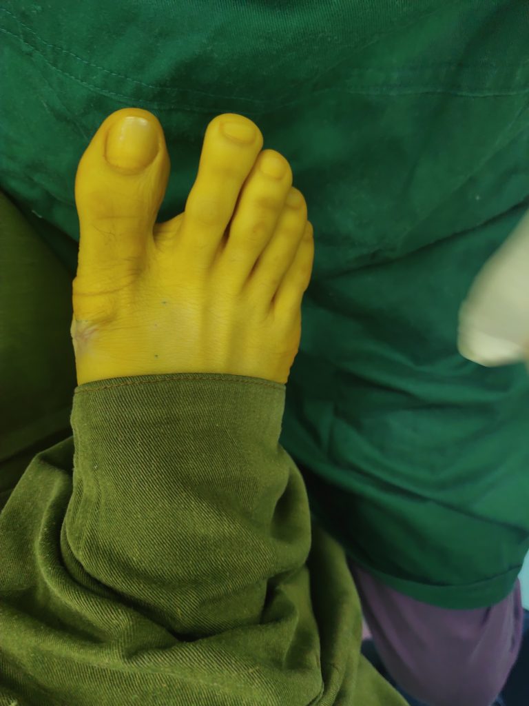 轻度的拇外翻医院有治疗的方法吗,为什么轻度拇外翻不建议做手术