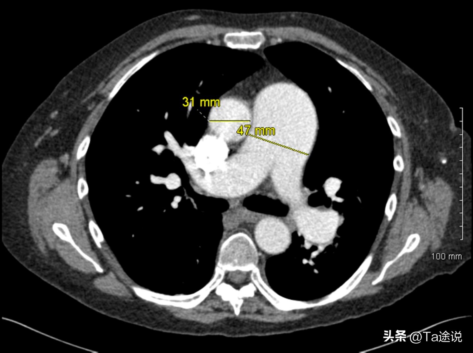女记者冒死生二胎,记者冒死产子换心脏