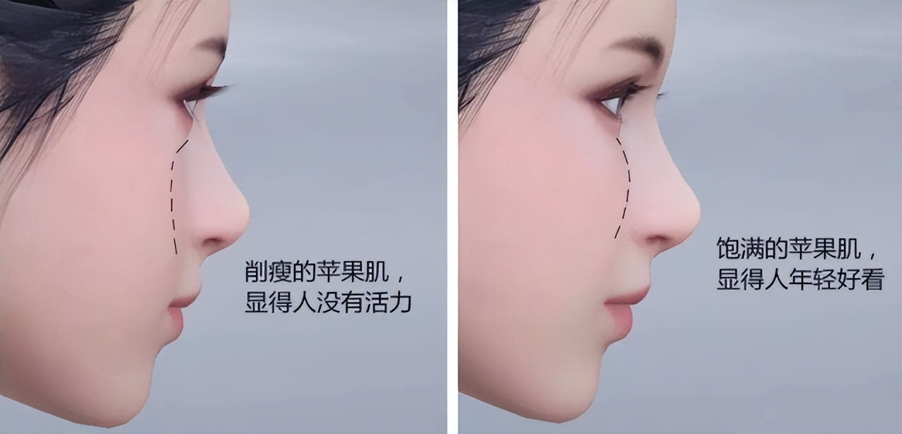 苹果肌塌陷不饱满怎么办,苹果肌干瘪怎么办