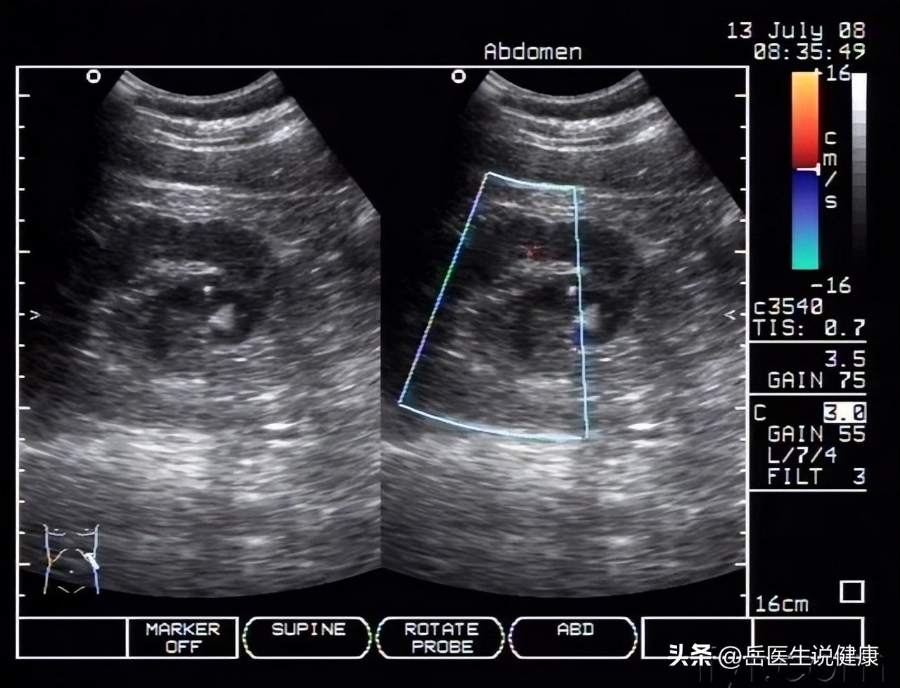 尿路感染用哪种抗生素好得快,尿路感染严重时是不是常用抗生素