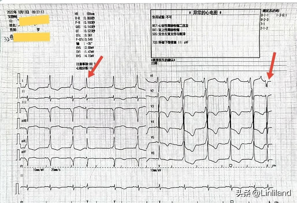 过速性房颤治疗,持续性房颤心动过速