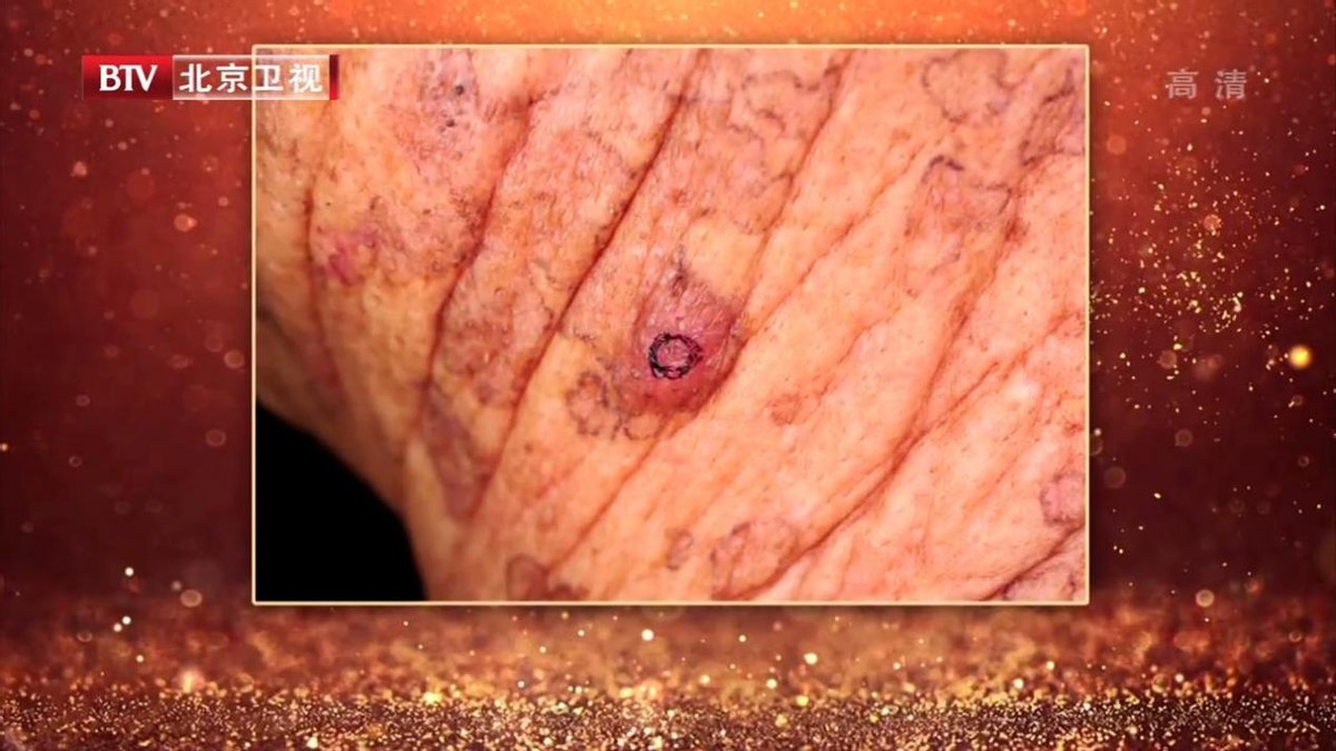皮肤上有黑点是癌症的前兆吗,皮肤长出红点要注意癌症的表现