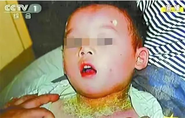 孩子药浴洗出绝症母亲肠子悔青,给孩子洗药浴洗出绝症