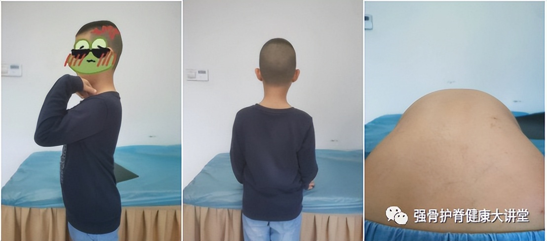 儿童脊柱侧弯治疗图,儿童脊柱侧弯最佳治疗方法