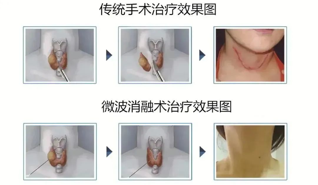 吃甲亢中药要忌口哪些食物,甲亢碘131治疗误区