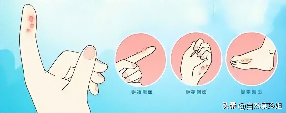 夏天手脚长小水泡很痒是什么原因,夏天长痒痒的水泡