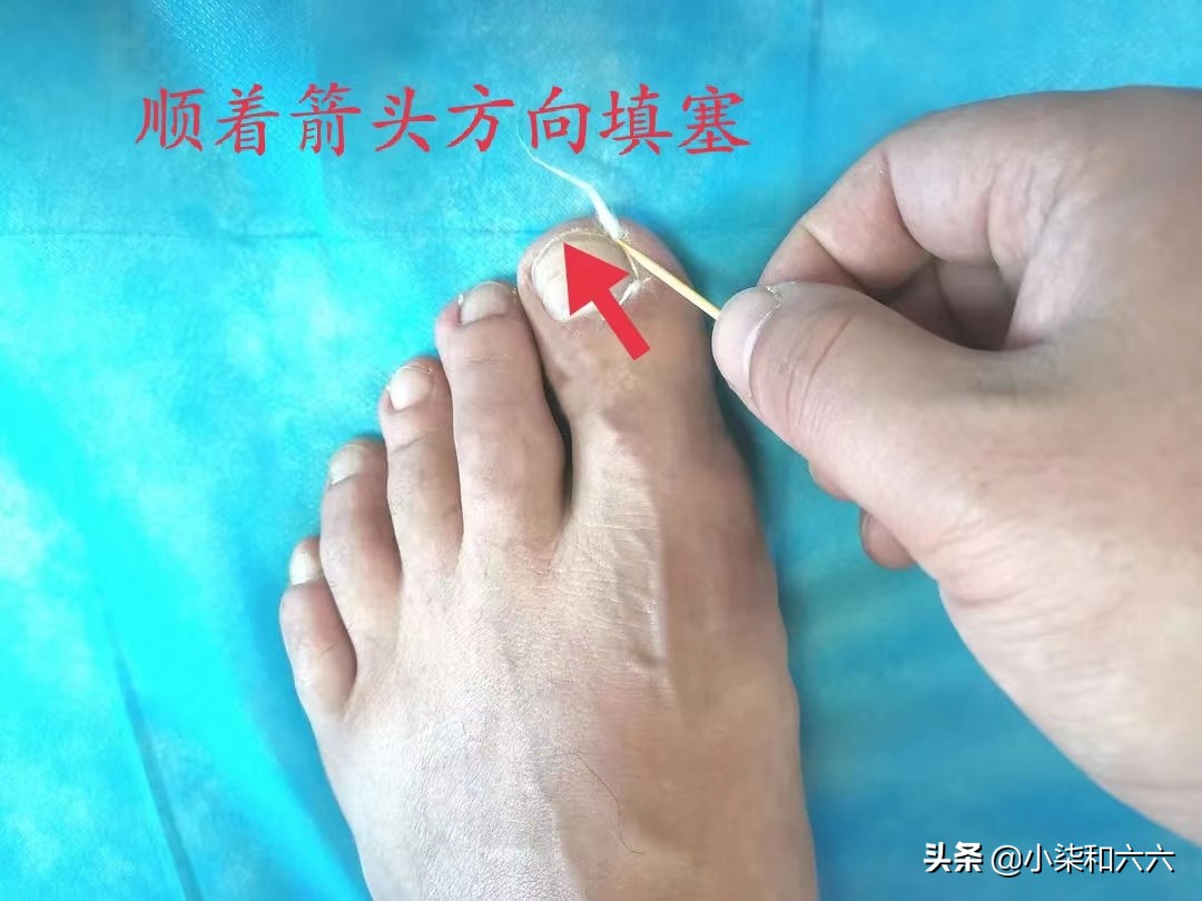 得了甲沟炎该怎么办？千万别急着拔甲