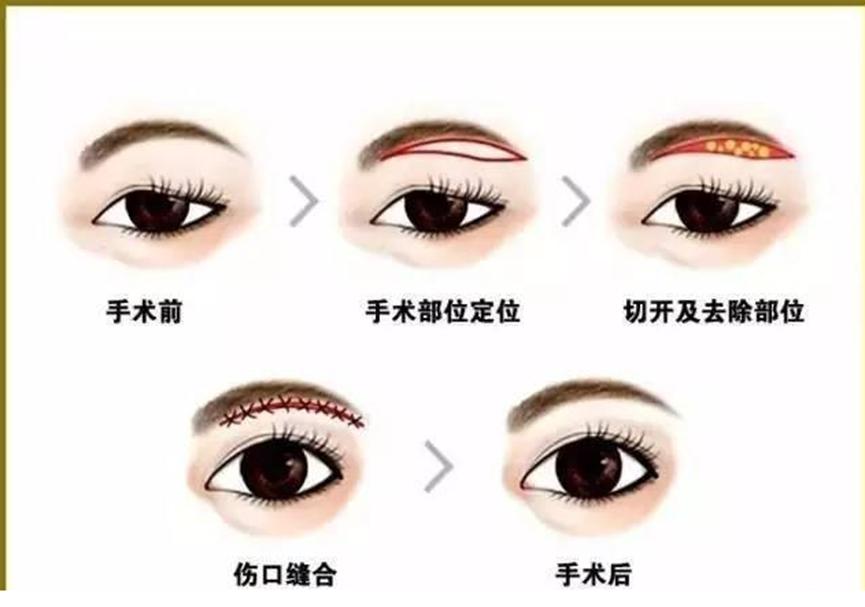 切眉和提眉哪个效果好有副作用吗,想做提眉和眼袋手术