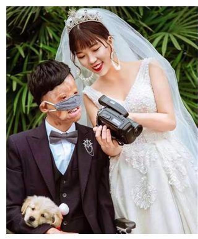 新郎救火时毁容新娘依然嫁给了他,新郎被烧伤新娘前往医院