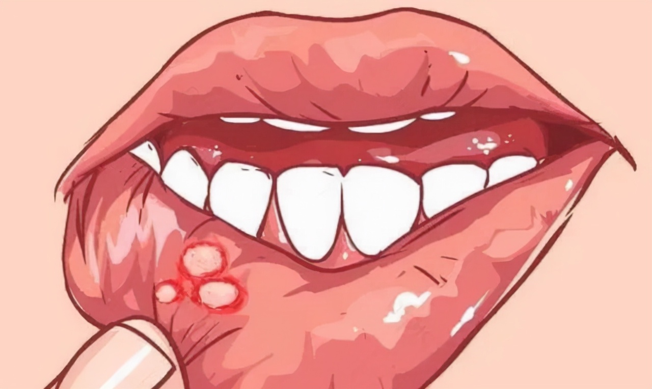 口腔癌早期症状是腮帮子酸牙有味,口腔癌早期治疗费用大概得多少钱