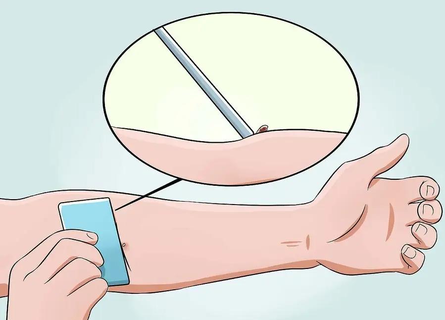 蜂蜇伤最好的处理方法,蜂蜇伤怎么处理