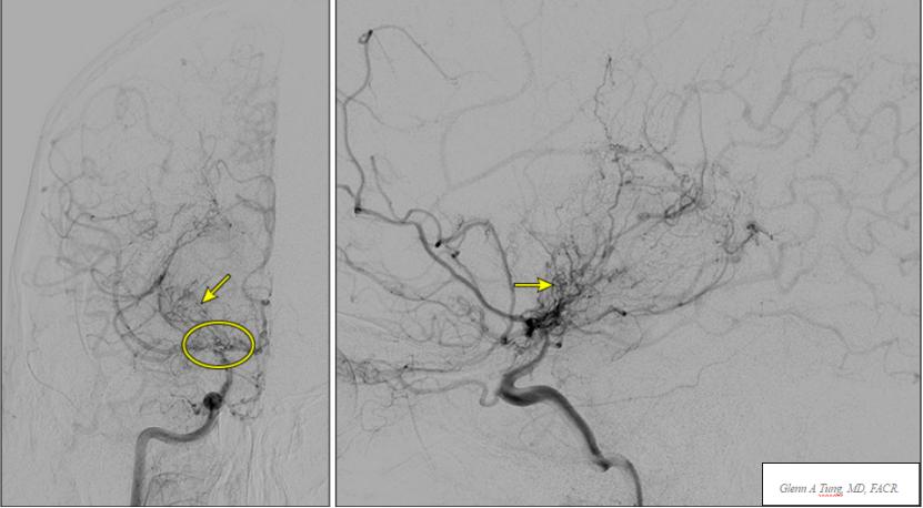 烟雾病手术后并发脑梗,烟雾病导致脑梗多长时间可以手术
