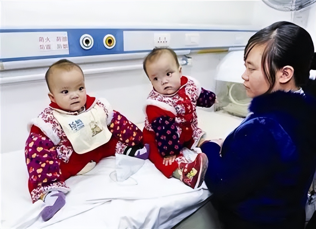 女子生下连体双胞胎后续,女子产下同母异父双胞胎完整版