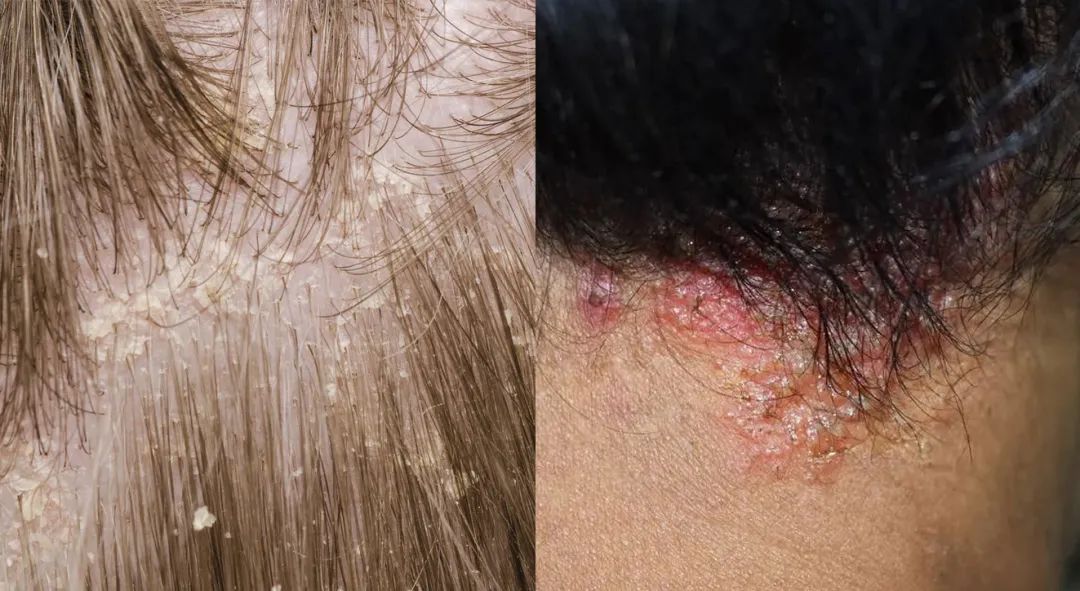 头皮发痒头屑多如何见效快,头皮发痒头屑多有什么好办法