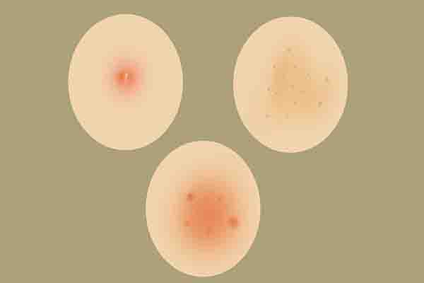 什么原因导致阴虱病,为什么会得阴虱怎么得的