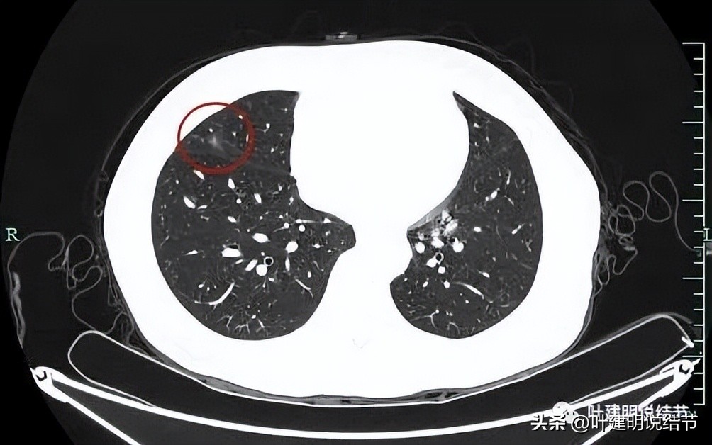 辽宁省肺结节手术哪家医院好,辽宁肺结节手术医院