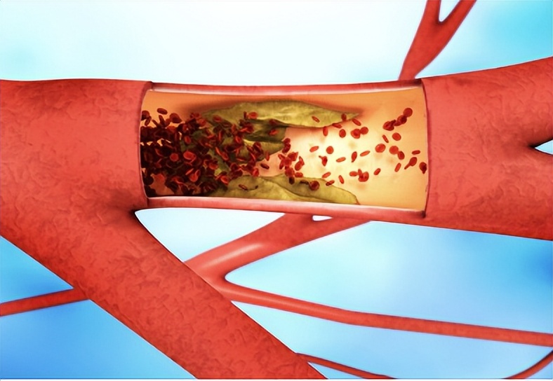 55岁男子停药倍他乐克后死亡,脑出血患者可以吃倍他乐克么