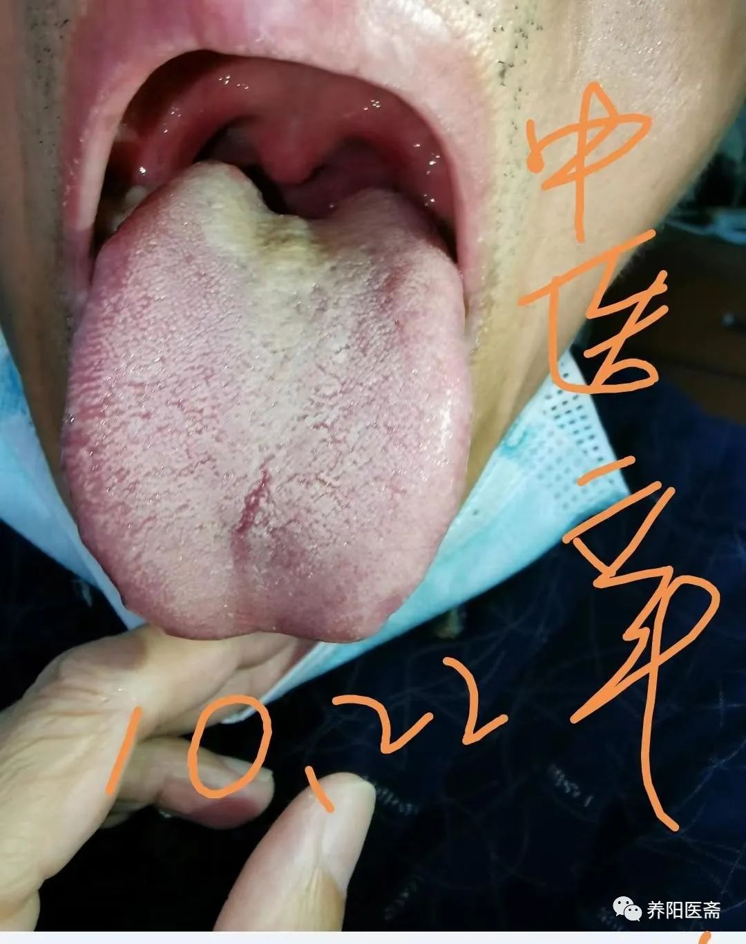 半夏泻心汤治幽门螺杆菌胃炎40例,半夏泻心汤治肝胆湿热兼胃炎医案