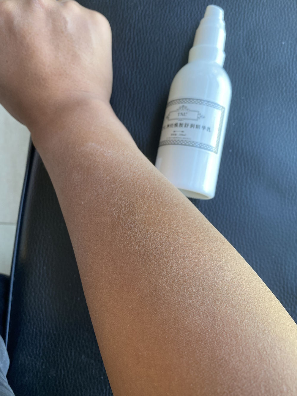 一到秋冬季双手就脱皮怎么治疗,一到春天手心就开始干燥脱皮