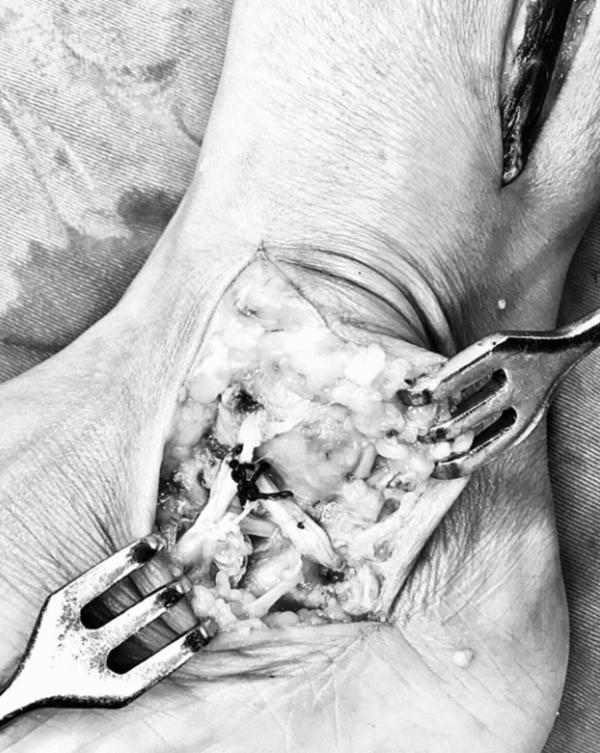 踝关节韧带损伤病历模板,踝关节外侧韧带损伤发病原因