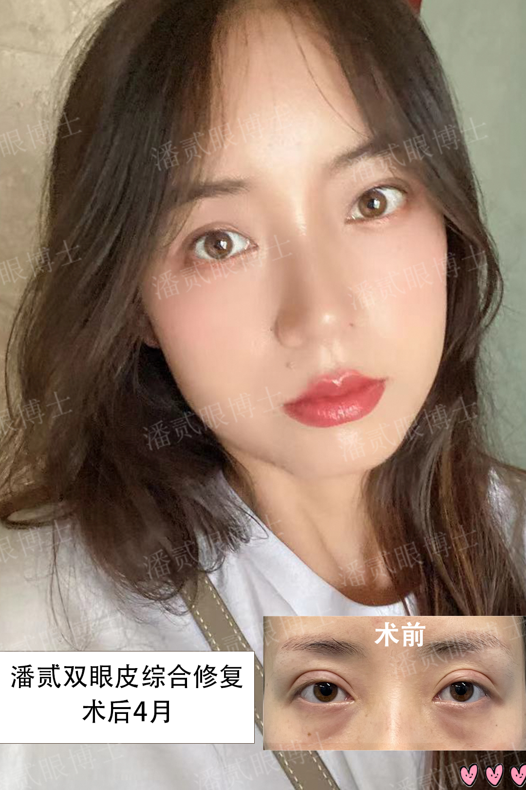 割双眼皮失败女的视频最新,割双眼皮失败女网红