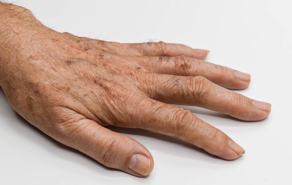 身上长黑点跟年龄有关吗,身体上黑点越来越多是什么原因