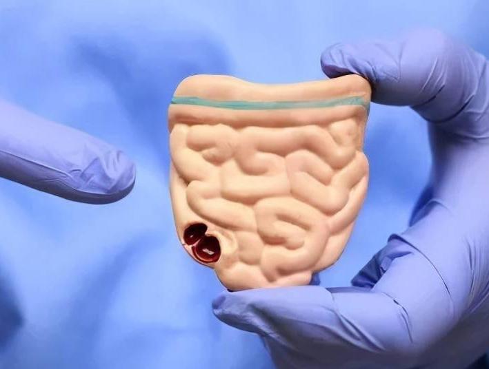 结肠癌术后化疗注意事项,结肠癌术后饮食注意事项有哪些