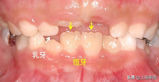 孩子换牙期的四个忠告,孩子换牙期须知的事