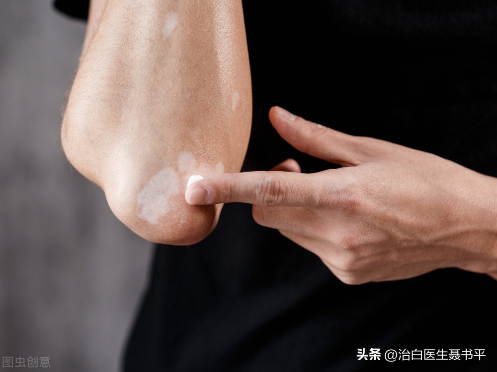 白癜风不痛不痒也不扩散，就真的没有必要治疗吗？