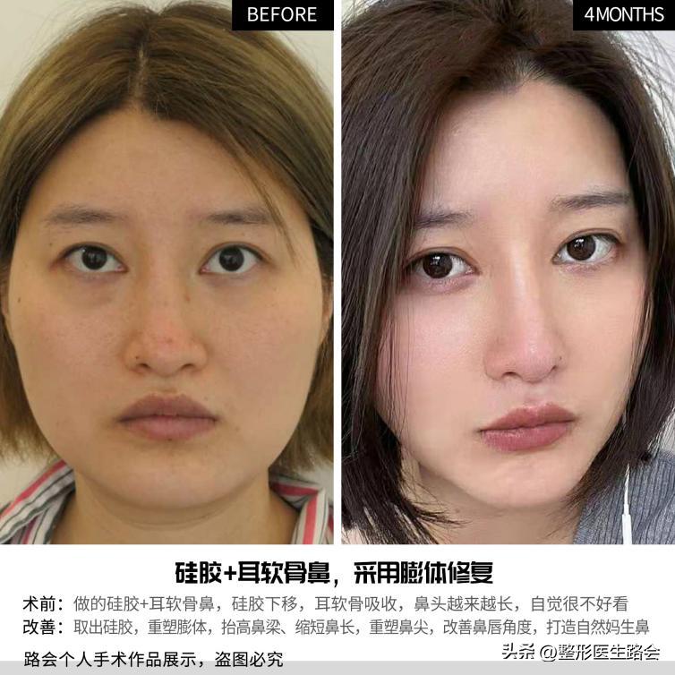 硅胶隆鼻后鼻尖发红怎么回事,单纯硅胶隆鼻一分钟搞定