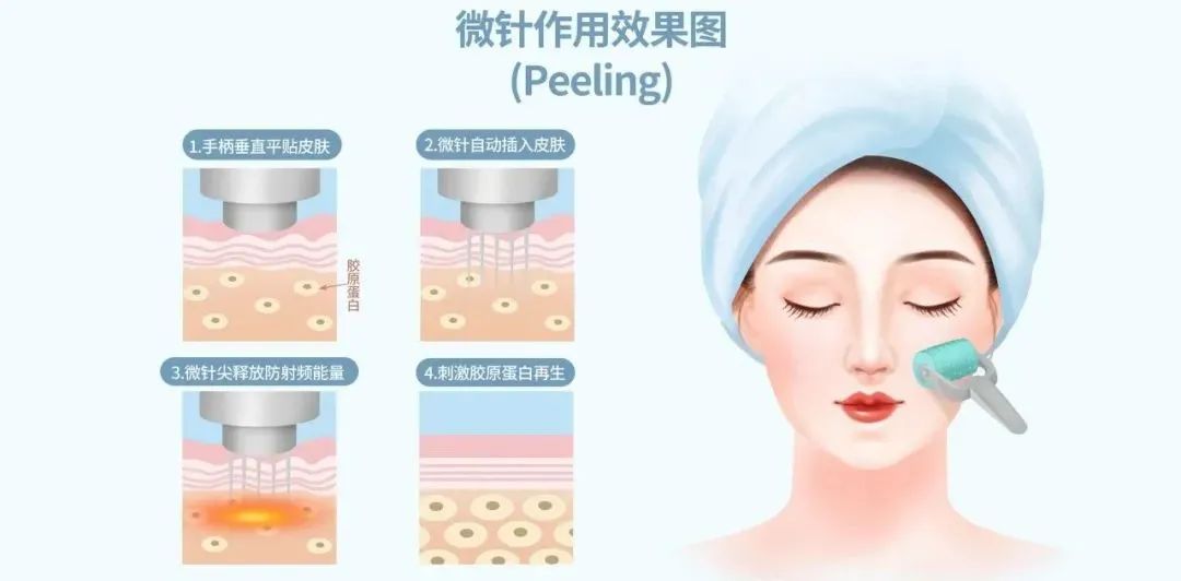 微针原理是什么,微针的原理是什么