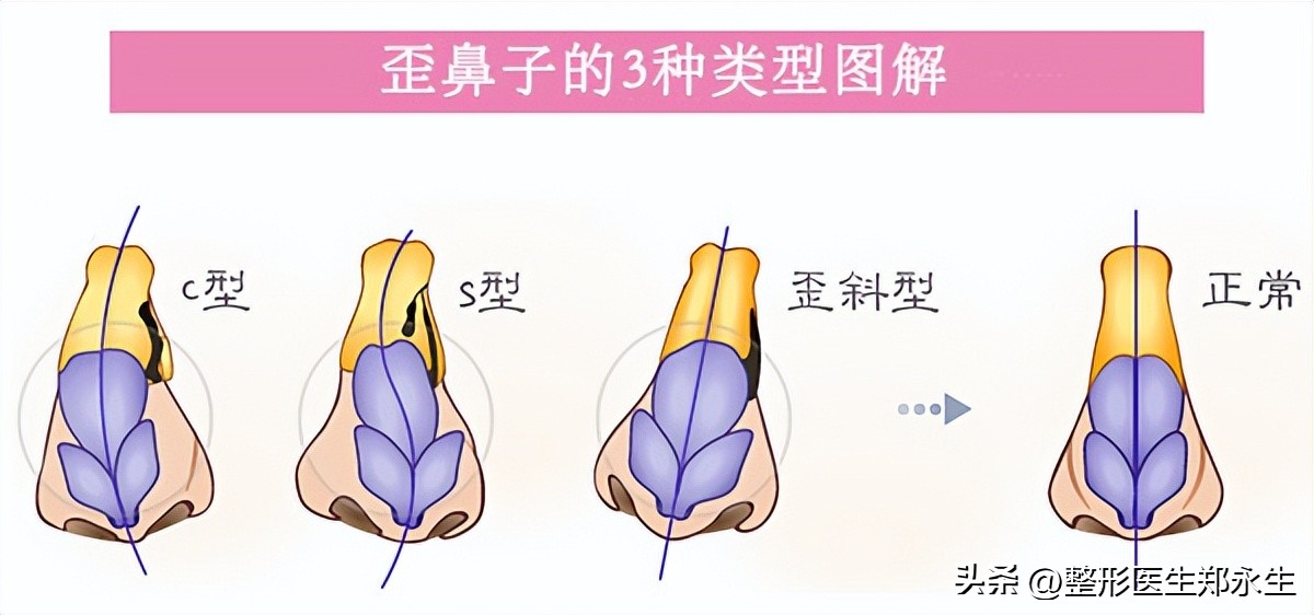 丑鼻子如何变成好看的鼻子,什么样的鼻子让人难看
