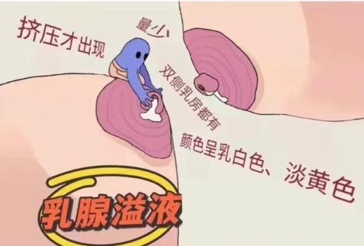 乳腺溢液最简单是什么病,乳腺溢液怎么才能知道是良性的