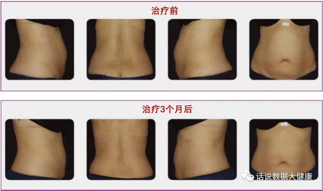 超声减脂注意事项,激光减脂和射频减脂的区别