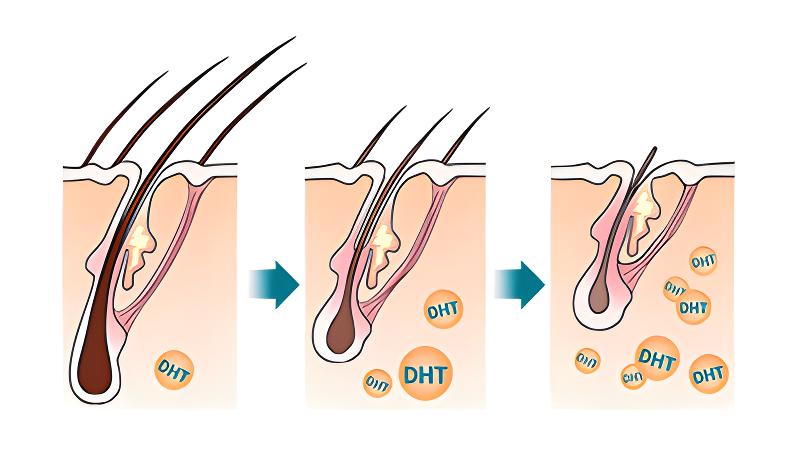 植发后又掉头发是什么原因,植发过后头发还是稀疏怎么办