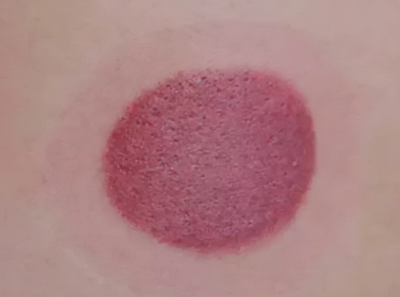 拔火罐时,后背吸出来的瘀血,是身体的毒素吗?真相来了