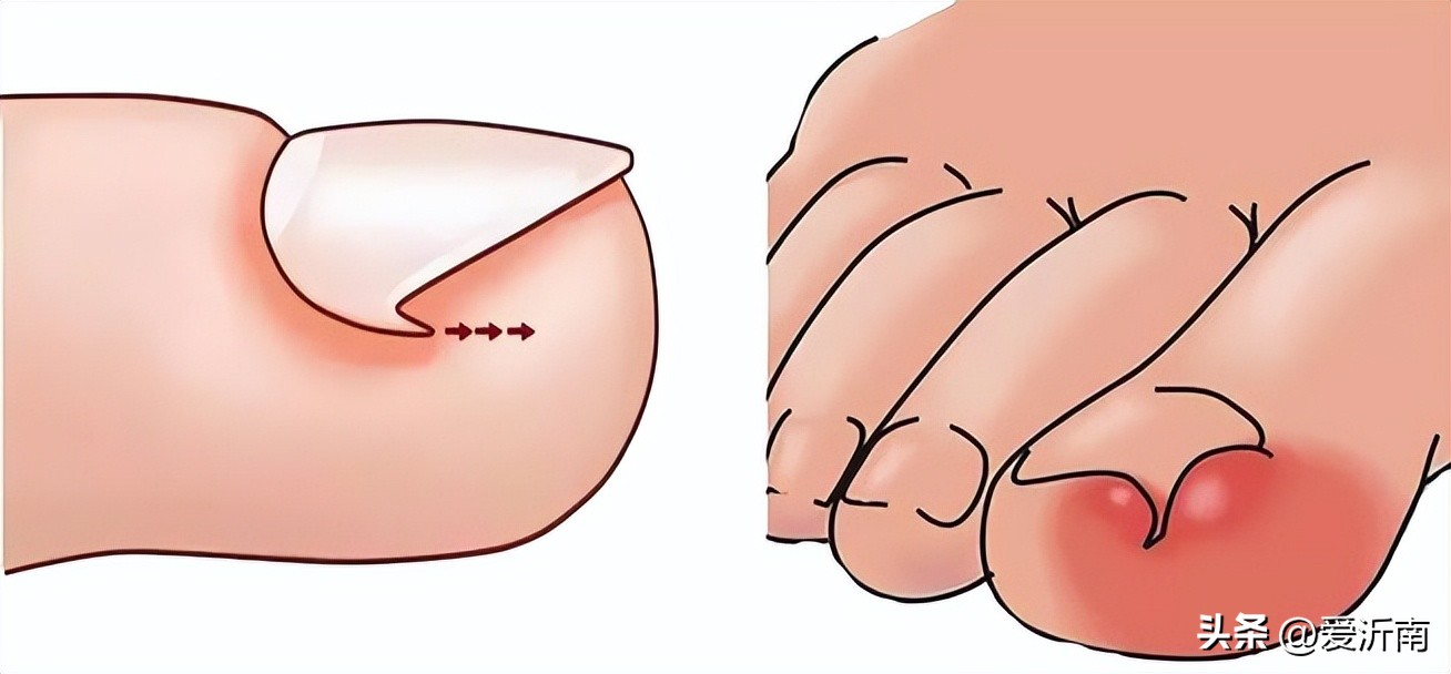 脚趾甲沟炎肿了涂什么药膏,小孩脚趾甲沟炎又红又肿怎样治疗
