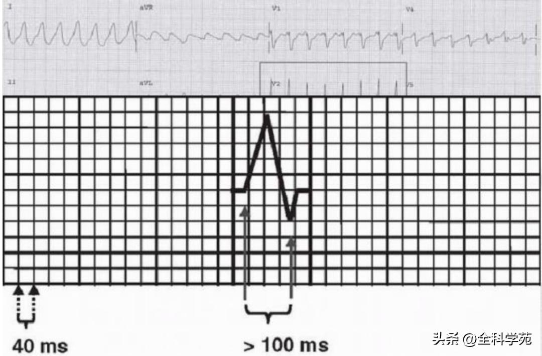 心电图上表现为宽qrs波,心电图中qrs是代表心动过速吗