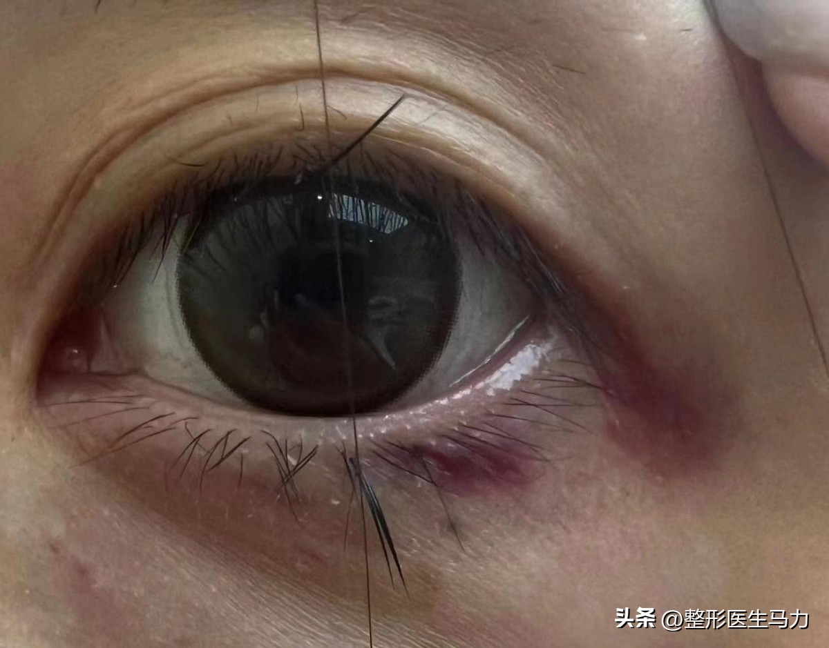 三甲医院注射玻尿酸都没事吧,三甲医院的医生注射玻尿酸专业吗