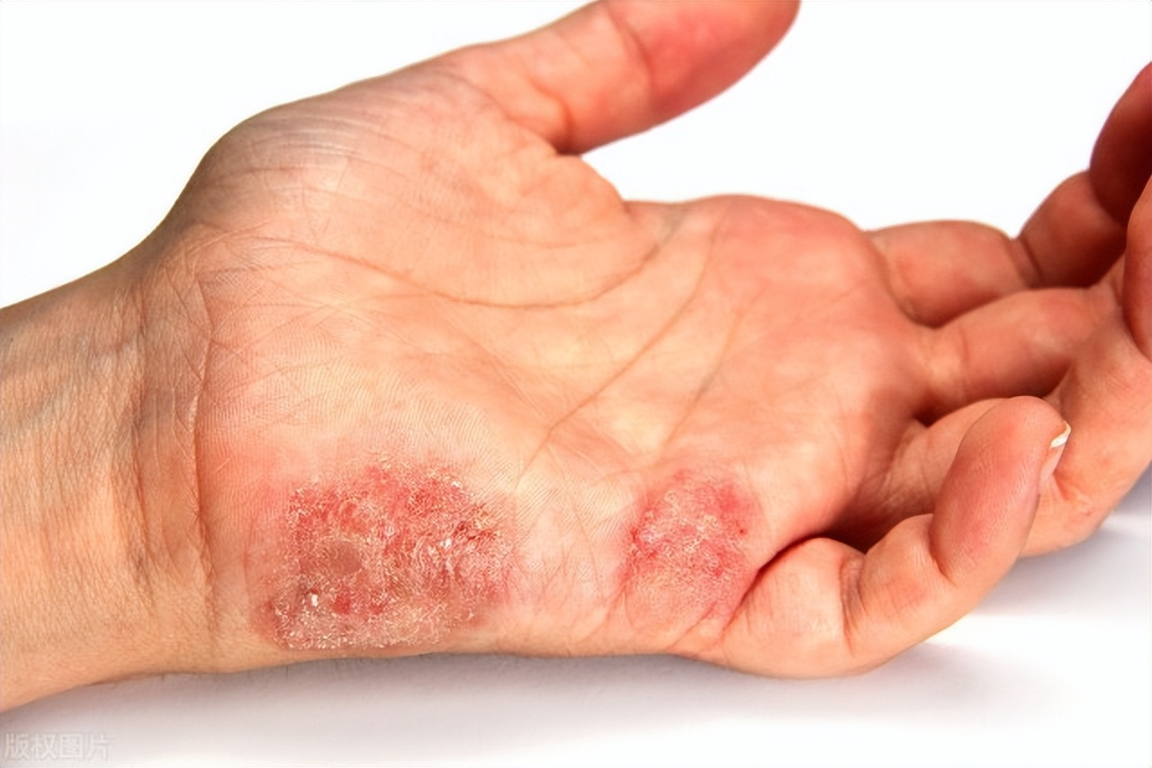 脖子上的小肉球可以自己消失吗,颈部小肉球那些事