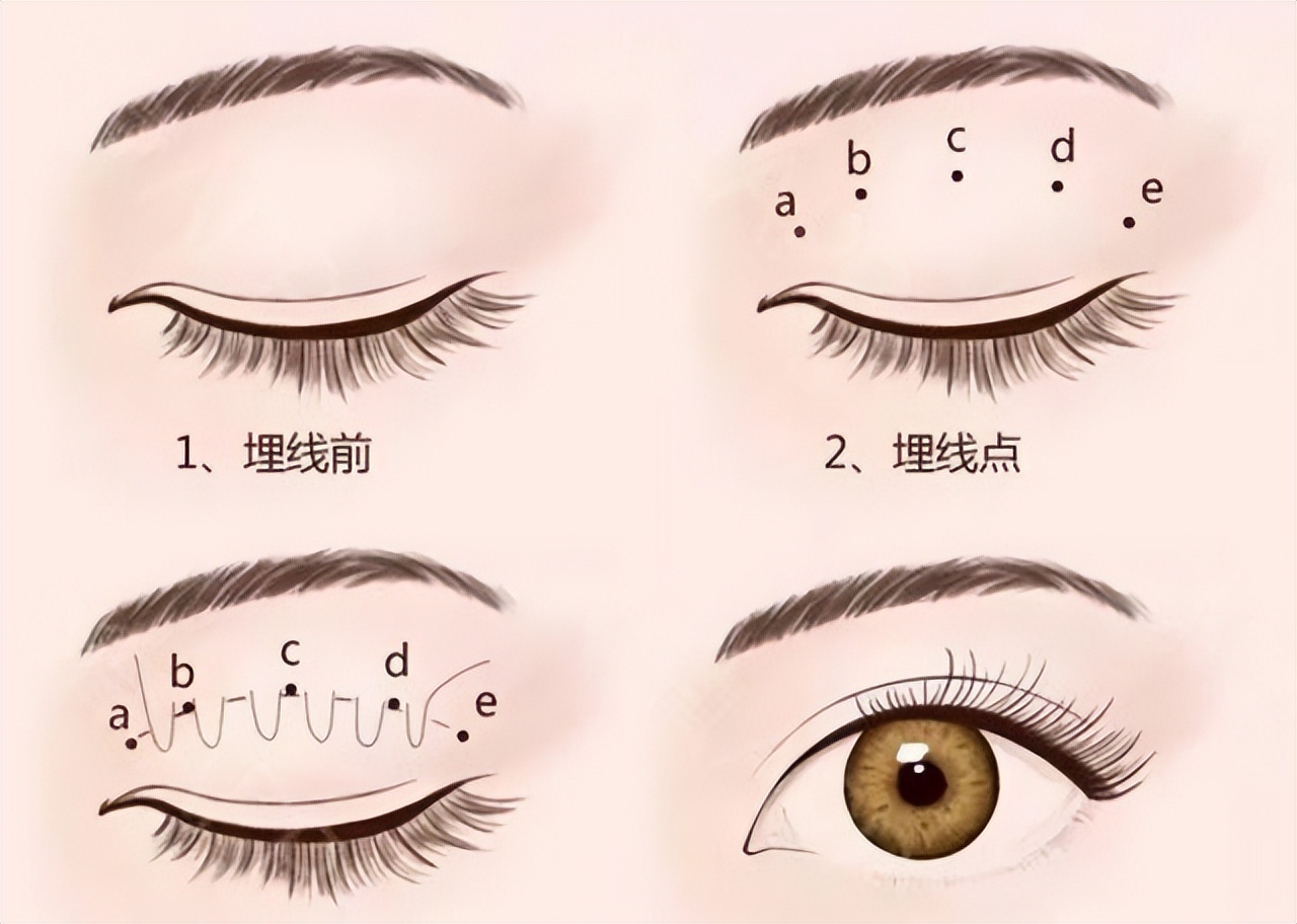 单眼皮肿眼泡该不该割,单眼皮肿眼泡真的不适合珠光色吗