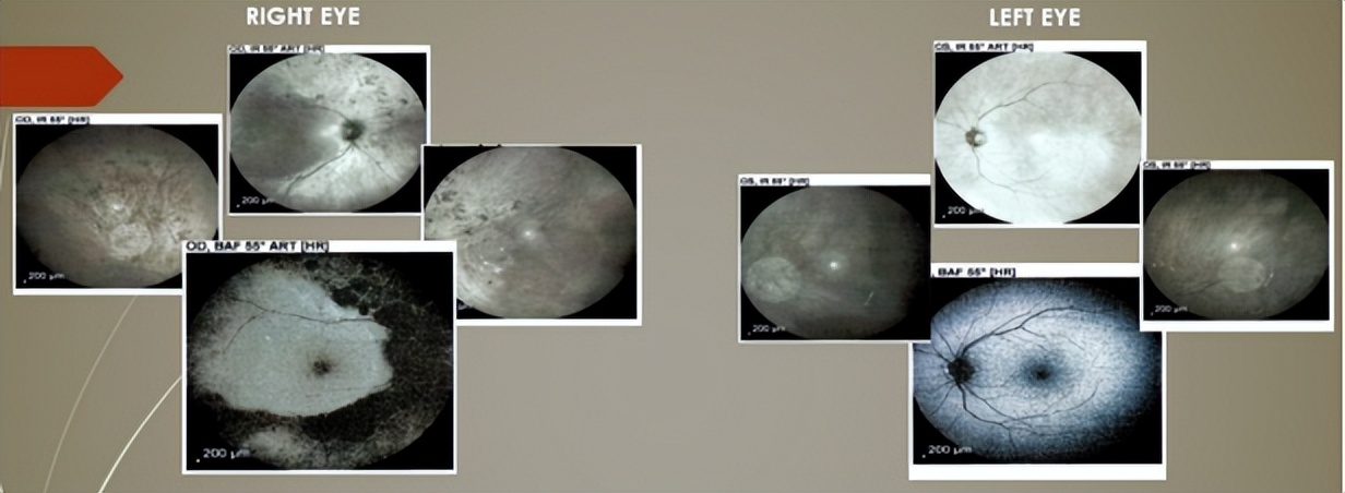 视网膜炎oct的详细图解,视网膜色素变性oct检查