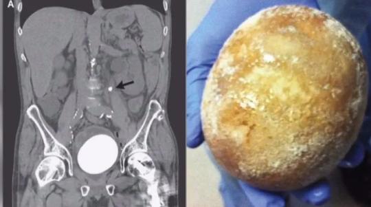 中医如何治疗猫咪尿路结石,猫狗肾结石