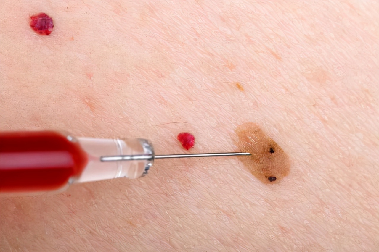 皮肤出现小红点像血点是怎么回事,皮肤上出现了小红点是什么症状